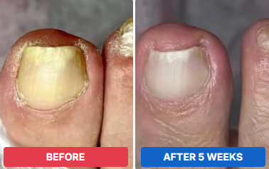 Cassie, TX before and after 5 weeks