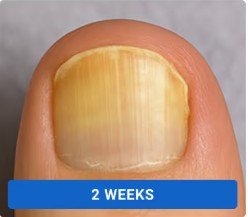 Toenail clearing progression with Orivelle - week 2