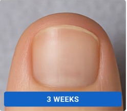Toenail clearing progression with Orivelle - week 3
